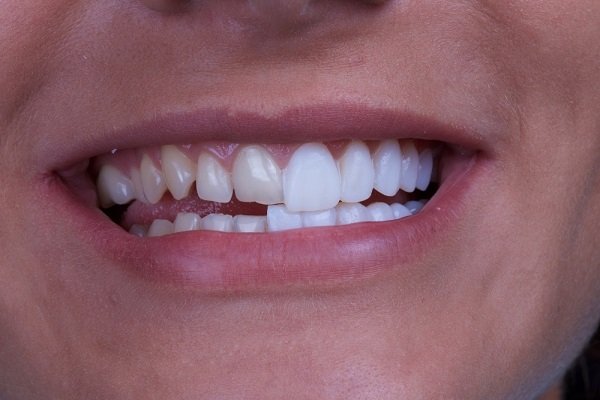 Dán răng sứ veneer có tính phức tạp