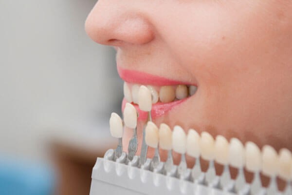 Phương pháp làm đẹp cho hàm răng
