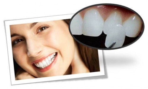 Phương pháp cải thiện hàm răng