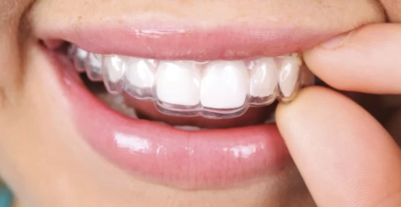 Giải pháp mới cho hàm răng đẹp