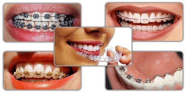 Các phương pháp niềng răng thẩm mỹ
