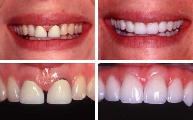 Dán sứ veneer cải thiện hàm răng của bạn