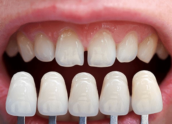 Dán răng sứ có đau không?