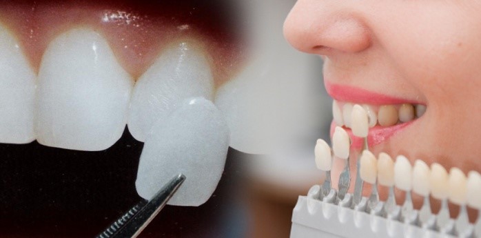 Những điều cần biết về dán răng sứ veneer
