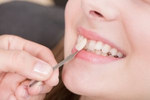 Lợi ích của dán răng sứ veneer