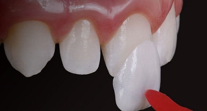 Dán răng sứ veneer mang đến nhiều ưu điểm tuyệt vời